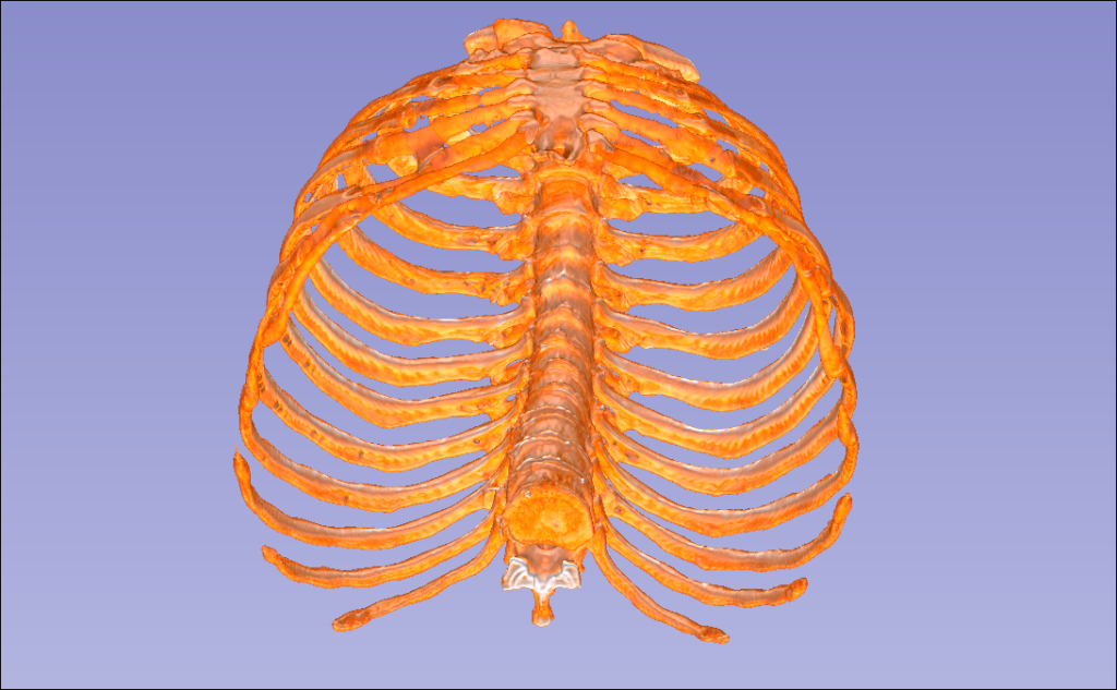 图片[1]-肋骨三维重建-临床影像实践