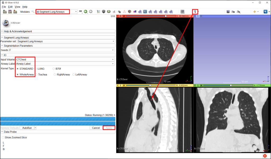图片[5]-快速气管分割-临床影像实践
